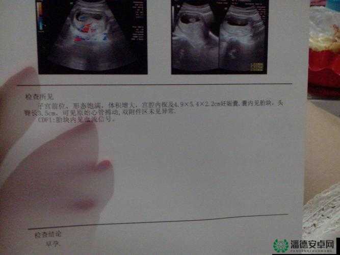 为什么 B 超会把男宝照成女宝？这种情况正常吗？